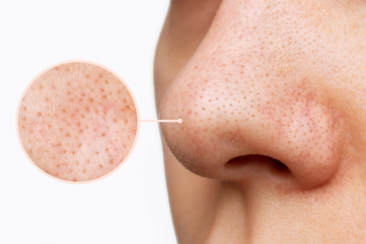 which microneedling to choose for post-acne pores and uneven texture