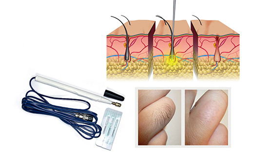 electrolysis hair removal machines alvi prague